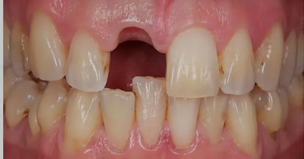 What Types of Dental Bridges Are Available?