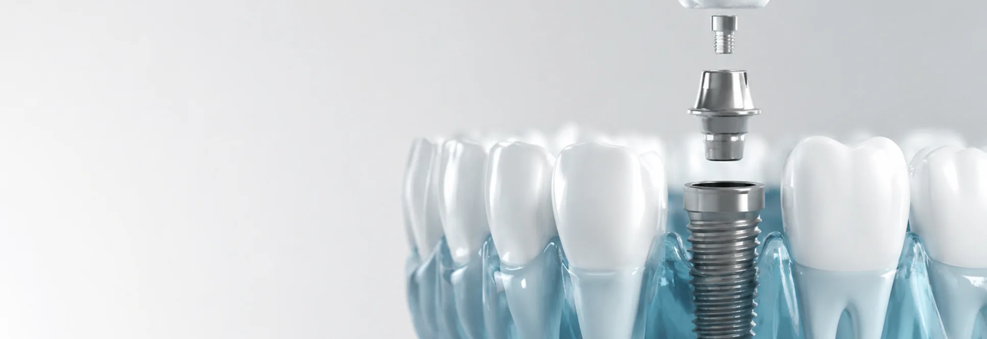 Computer guided dental implants at Finch Midland Dental