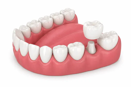 Porcelain crown restoration at Finch Midland Dental Scarborough